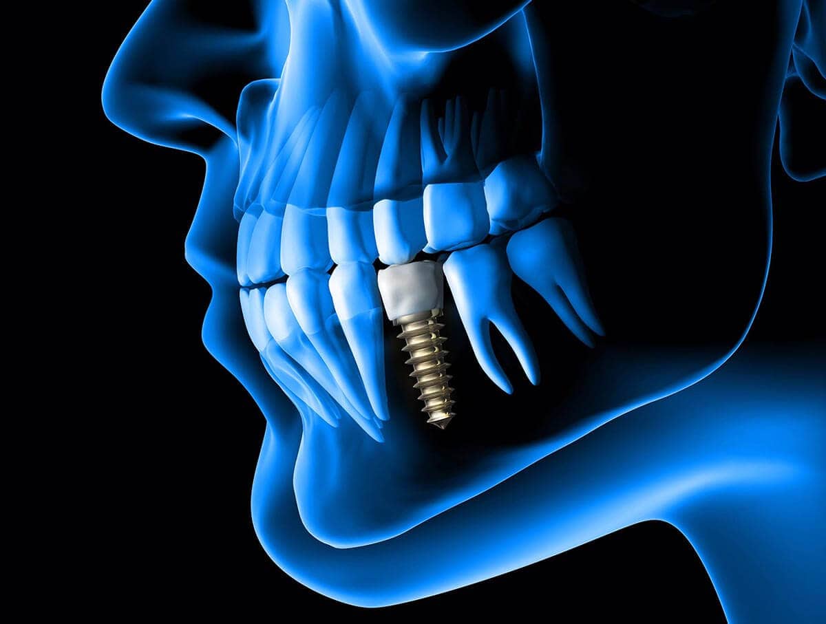 Xray of a mouth with an implant