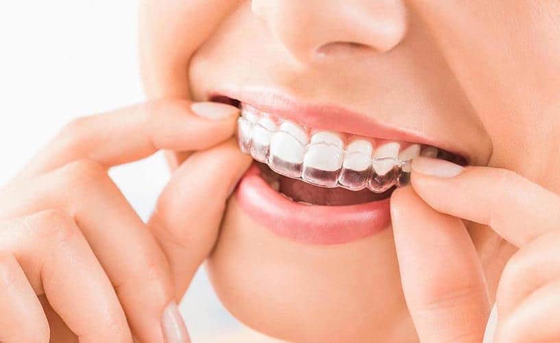 Invisible Braces – Dr. Mansuri's Cosmetic Dental Clinic